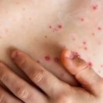 NYC reporta el primer caso de Mpox, una enfermedad infecciosa; emite alerta sanitaria